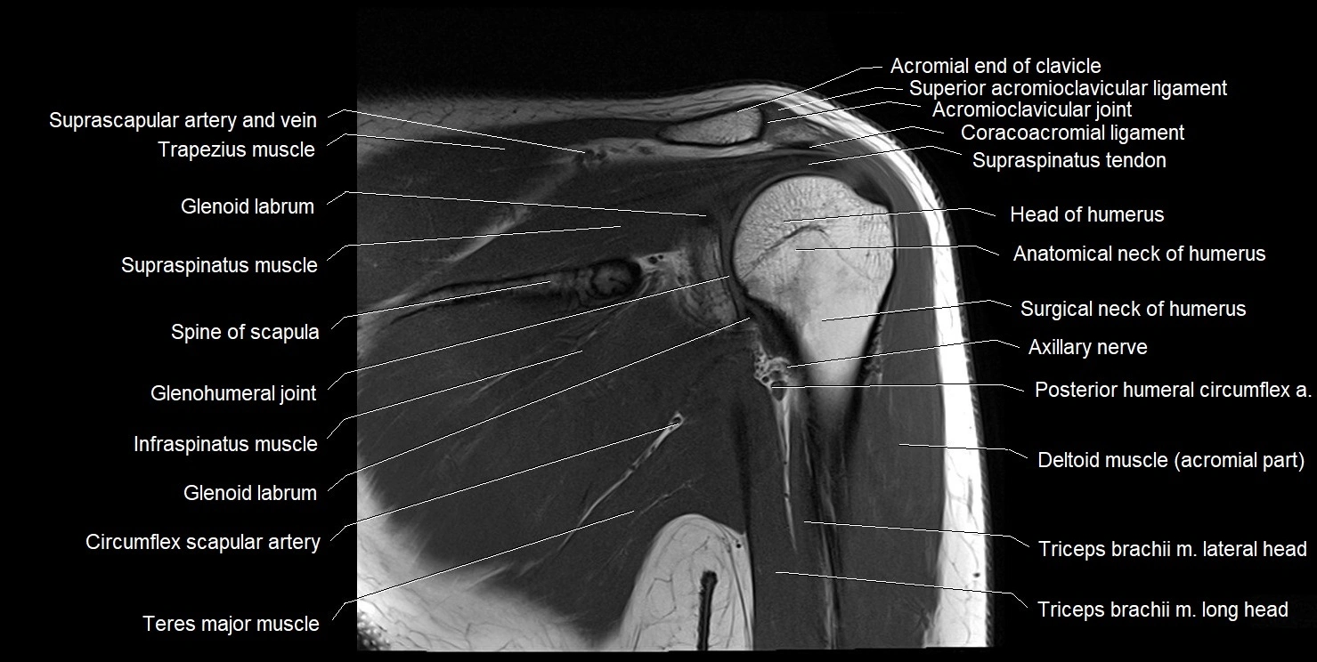 mri shoulder coronal cross sectional anatomy image 12.webp